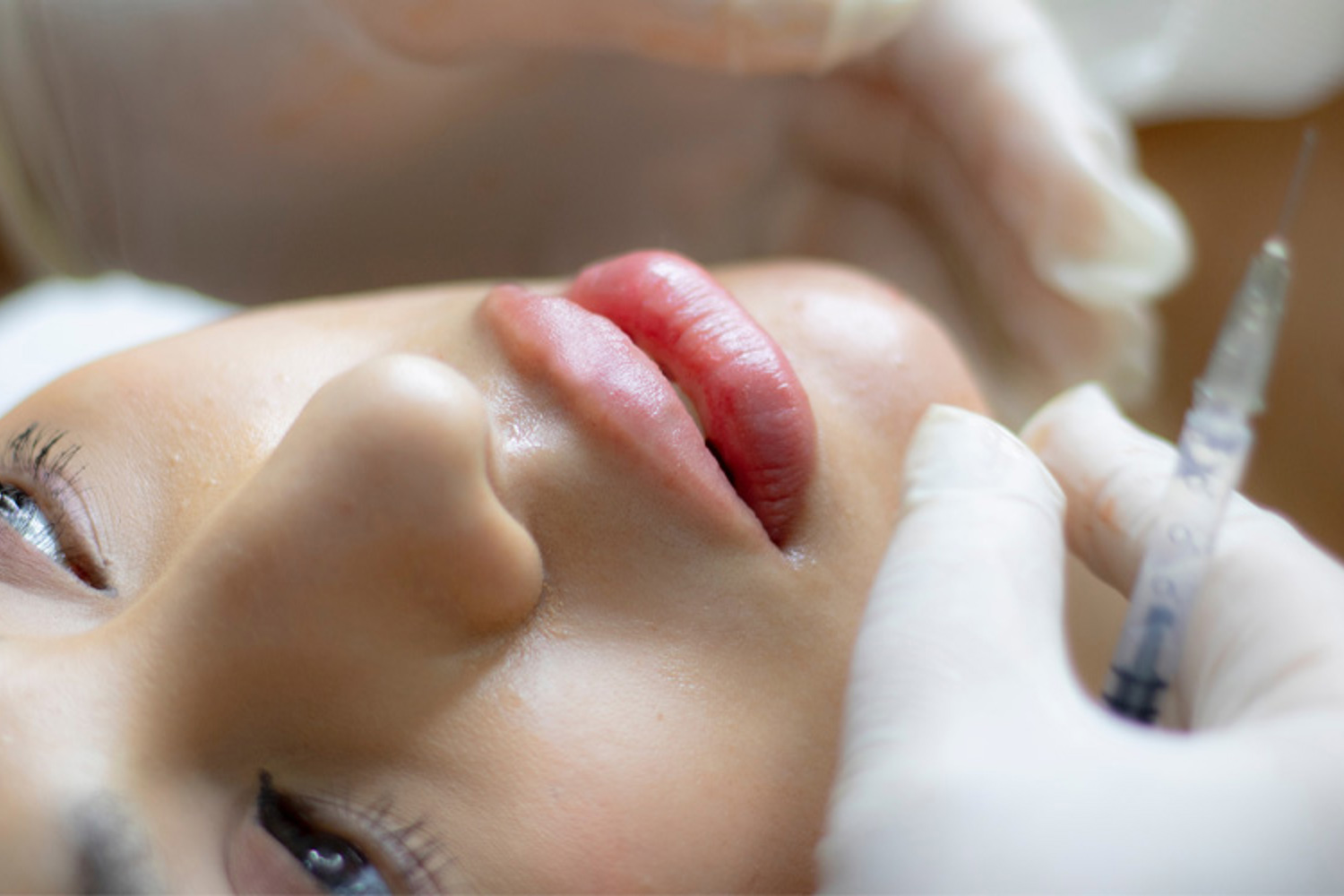 Lipfillers
